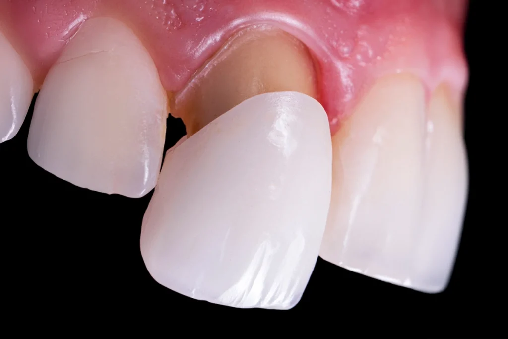 Dental Veneers Cost 2025