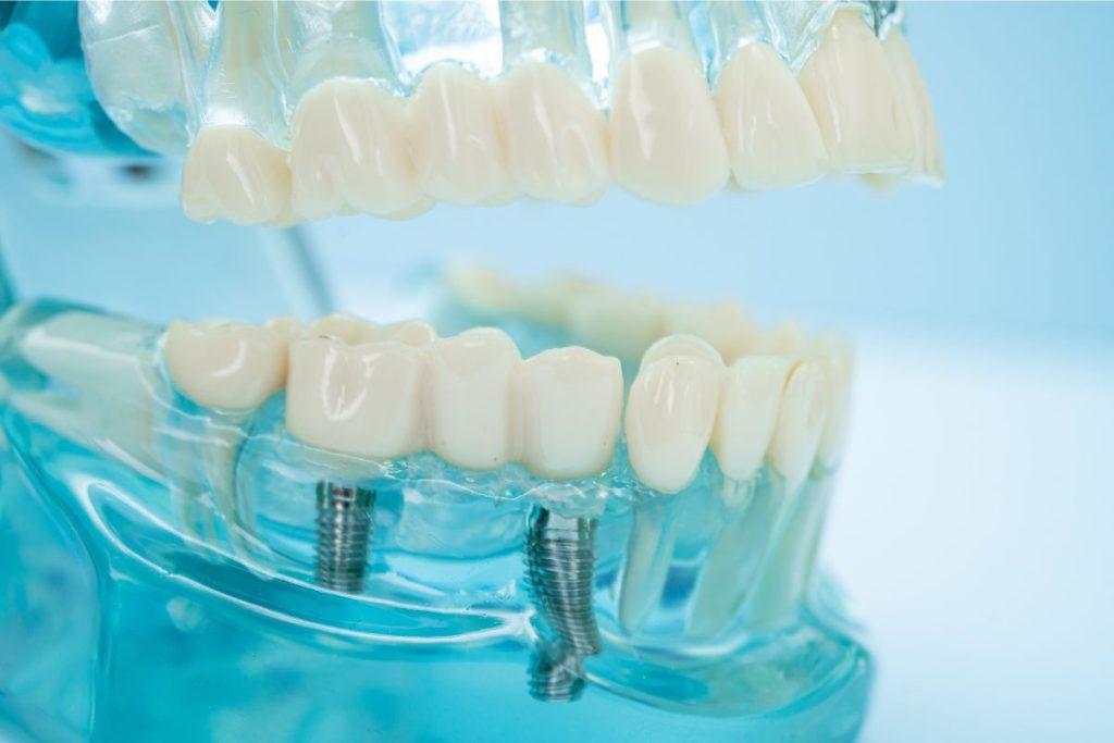 Best Dental Implants in Antalya 2025