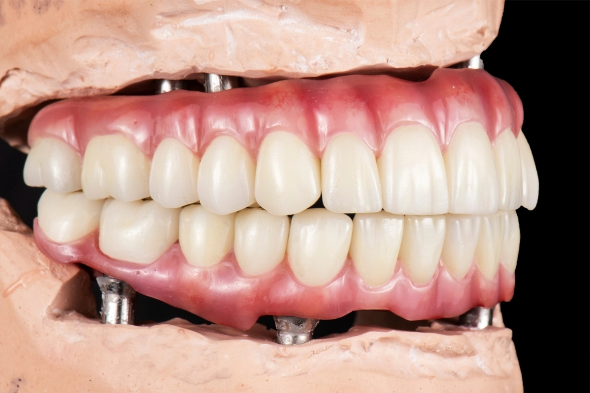 Dental implants in Antalya
