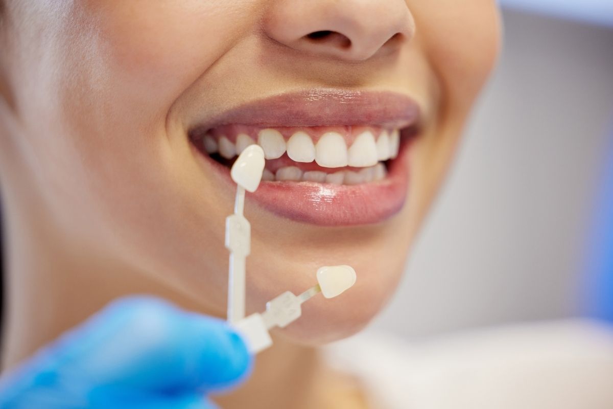 Dental Veneers Aftercare 2025