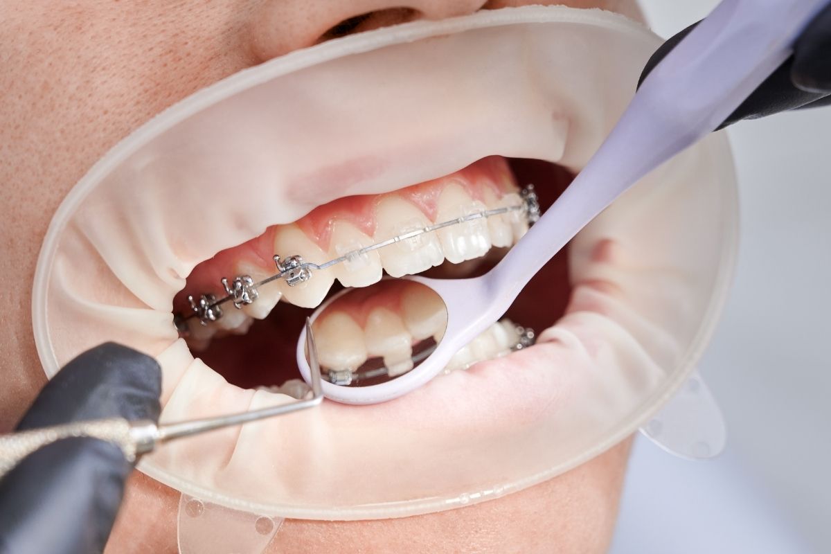 Orthodontic treatment aftercare 2025