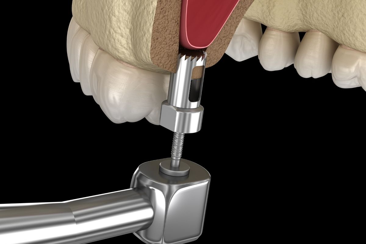 Sinus Lift Aftercare 2025