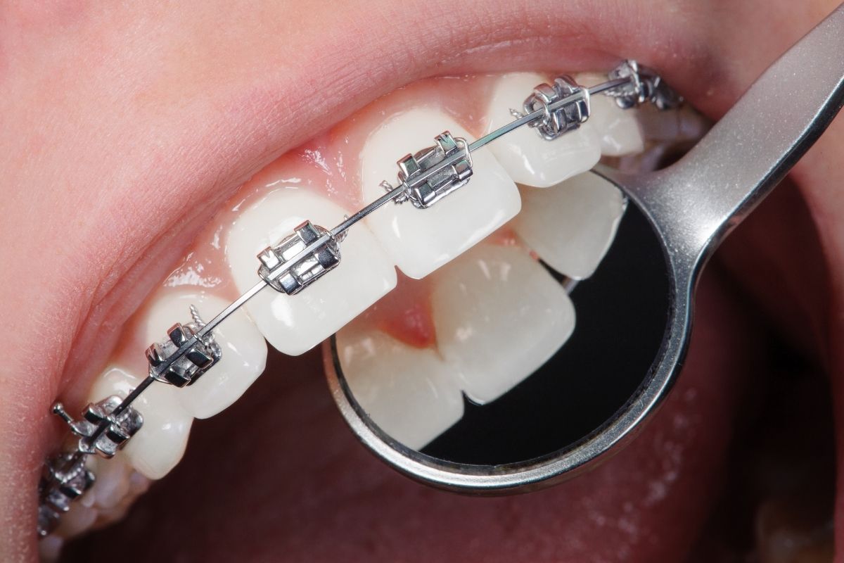 Get teeth done in Antalya 2025
