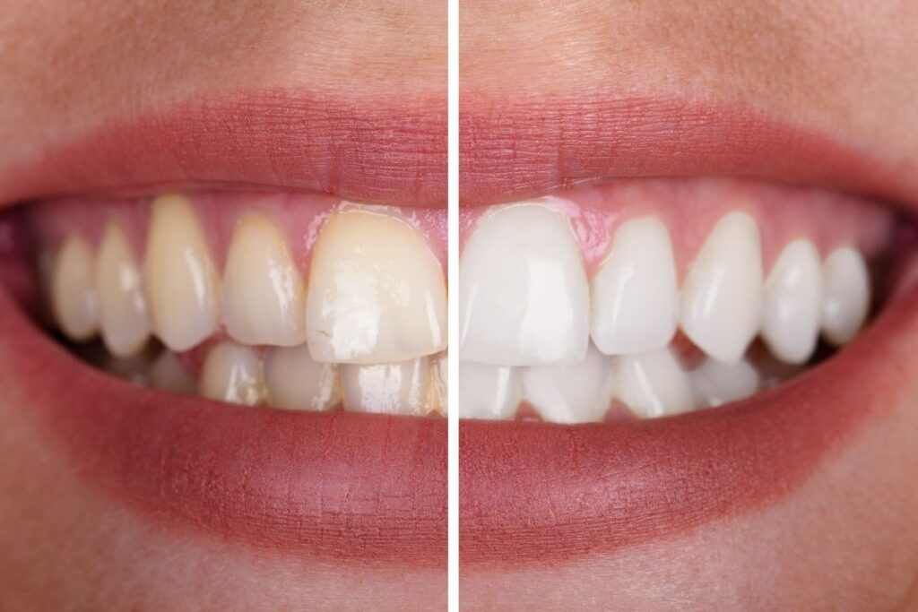 Top 5 Benefits of Getting a Smile Makeover in Antalya