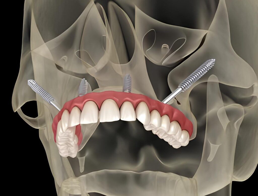 How long do zygomatic implants last