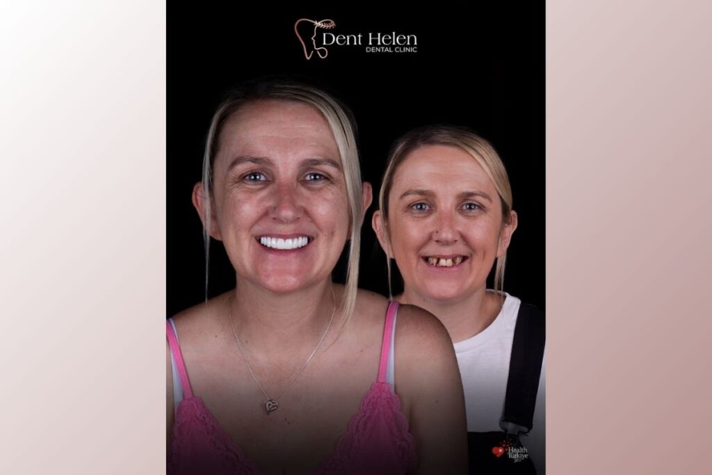 Zubní implantáty v Antalyi