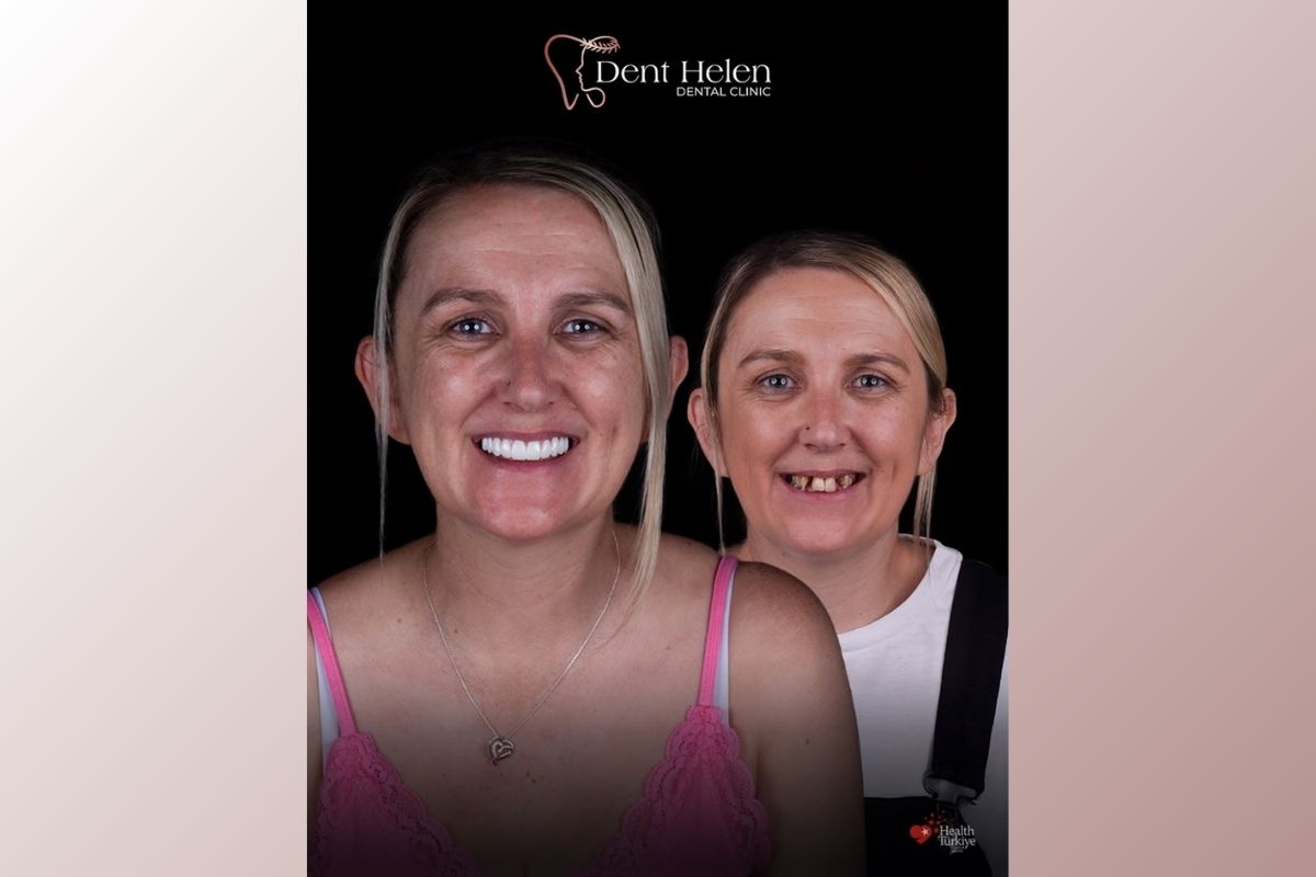 Zubní implantáty v Antalyi