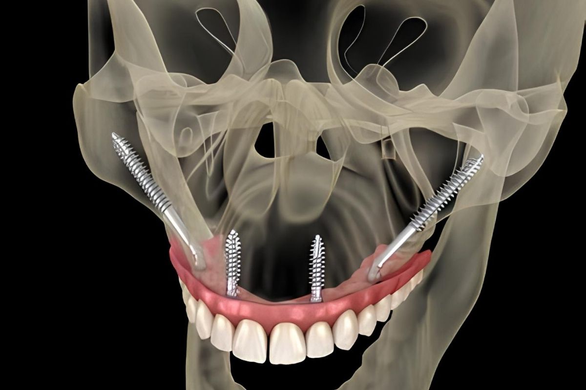 Zygomatic Dental Implants in Antalya