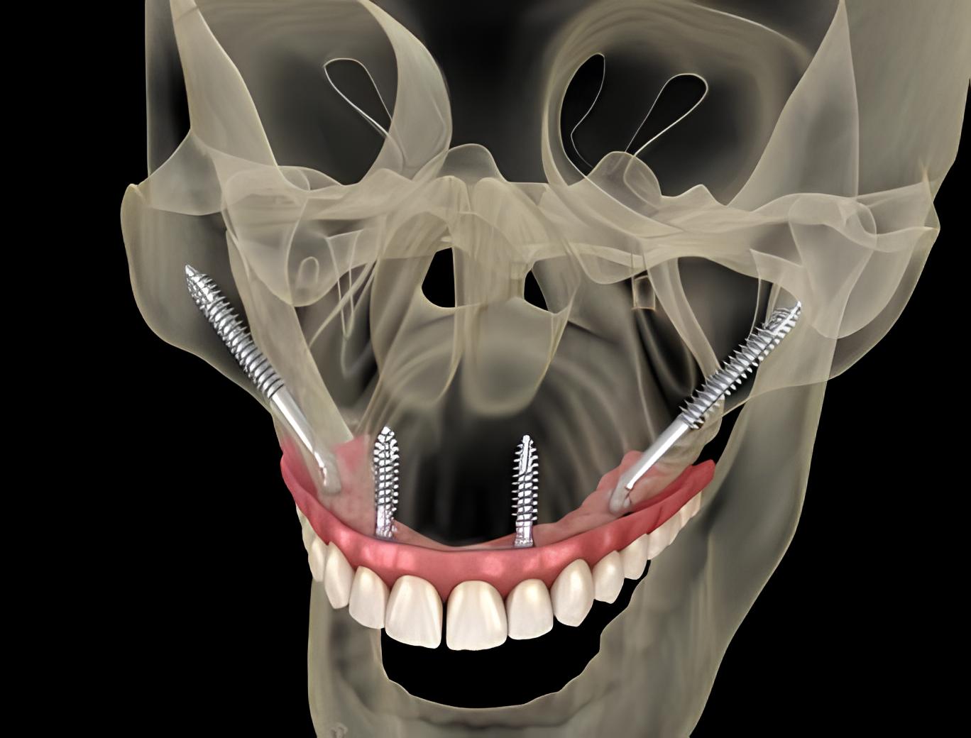 Zygomatic Dental Implants in Antalya