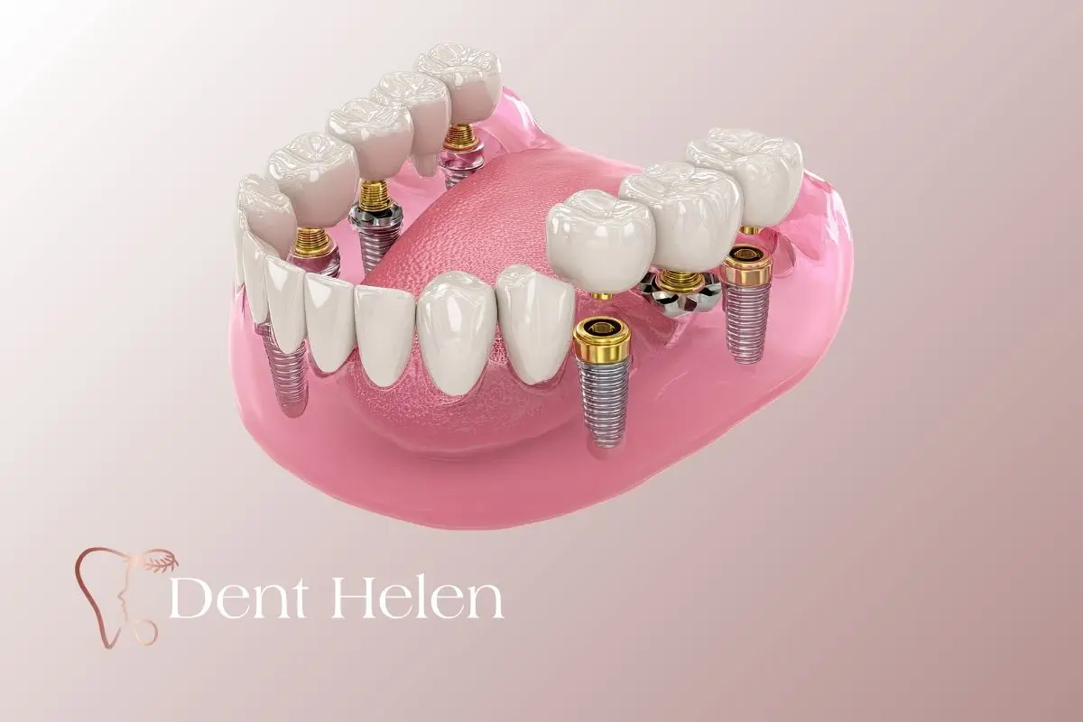 Implantes Dentários na Turquia