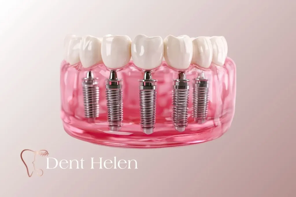 Quem é um bom candidato para implantes dentários