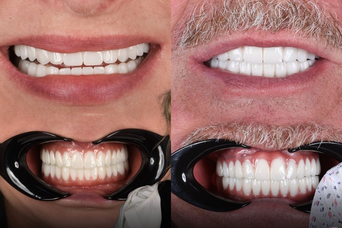 All-on-4 vs All-on-6: Full Mouth Implants in Turkey