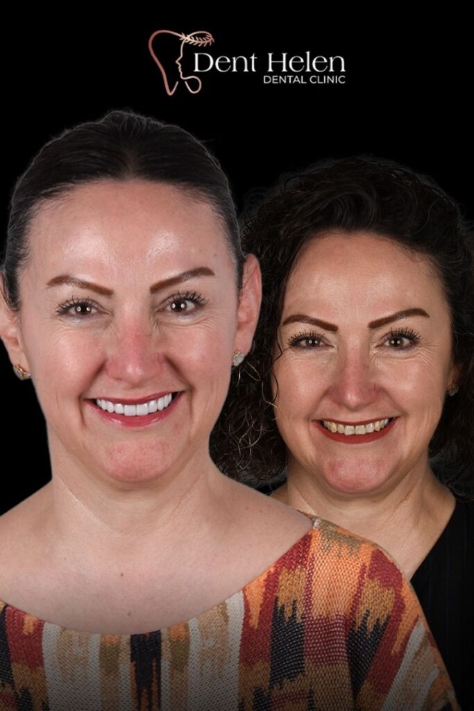 Dental Veneers Cost in Antalya