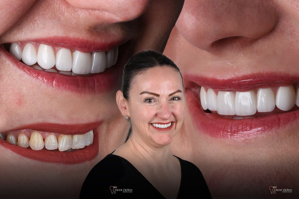 Dental Veneers Cost in Antalya