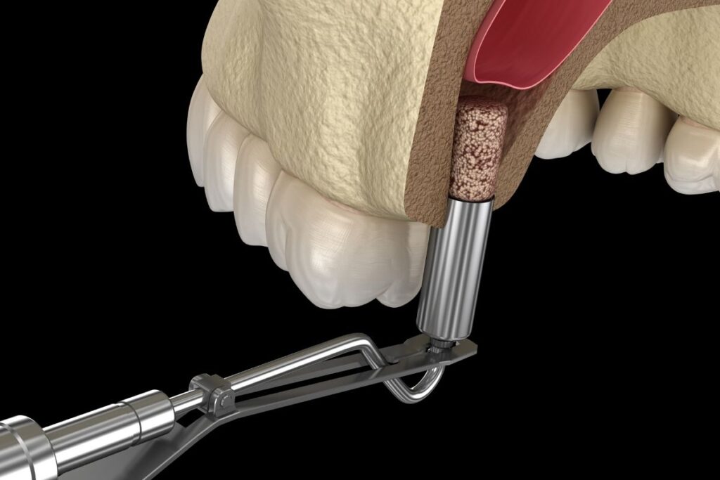Sinus Lift in Cost in Antalya