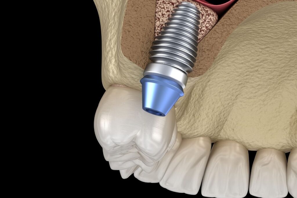 Sinus Lift in Cost in Antalya