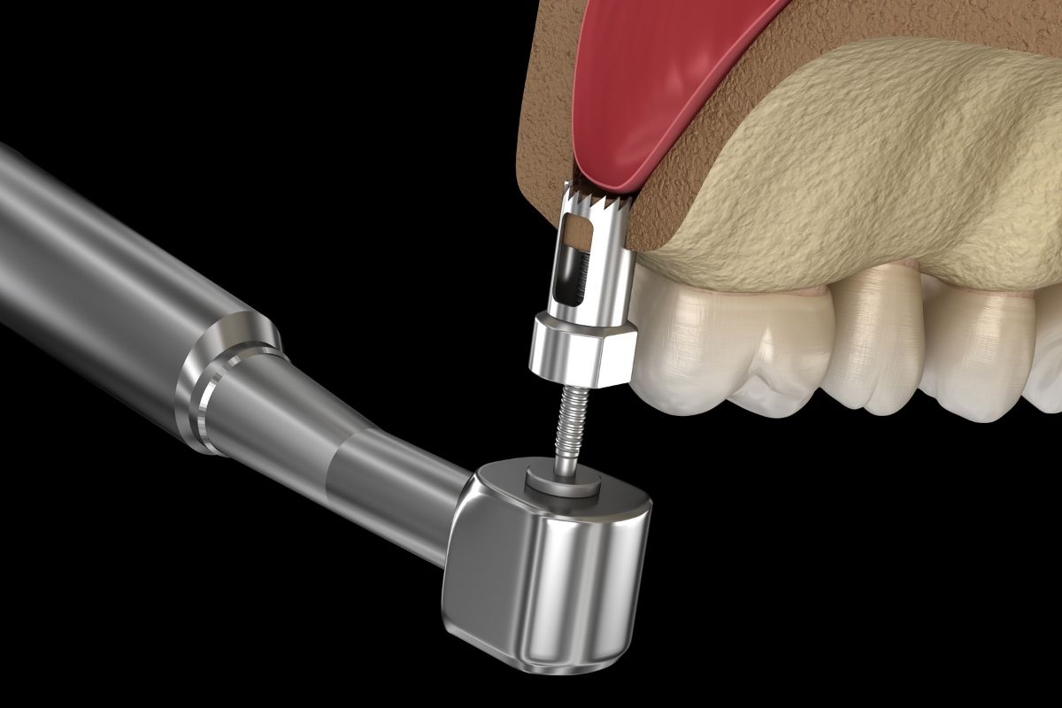 Sinus Lift in Cost in Antalya
