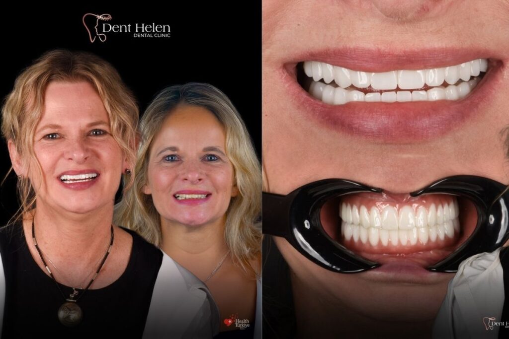 Implante dentário antes e depois