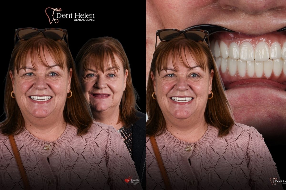 Implante dentário quanto custa