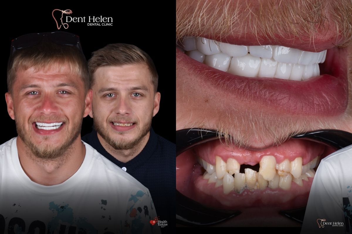 Dental Crowns Cost in Antalya