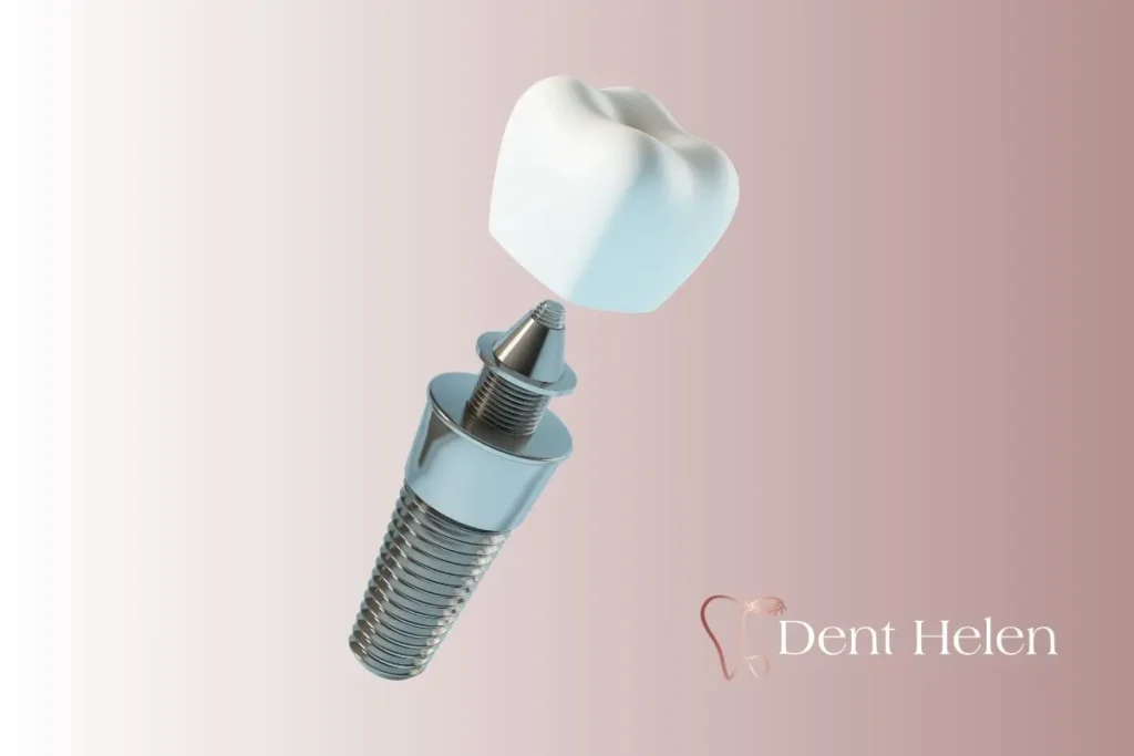 What to Do After Dental Implants? Aftercare & Recovery Guide