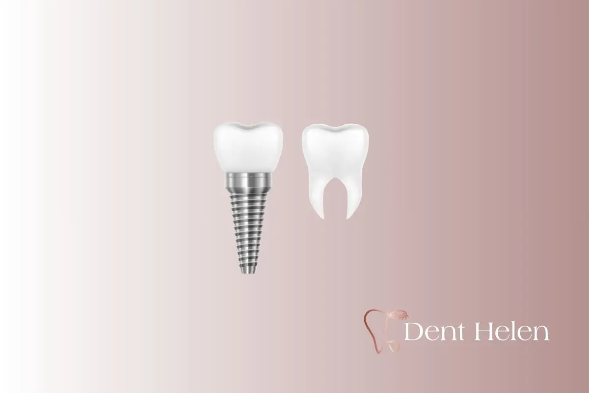 What to Do After Dental Implants? Aftercare & Recovery Guide