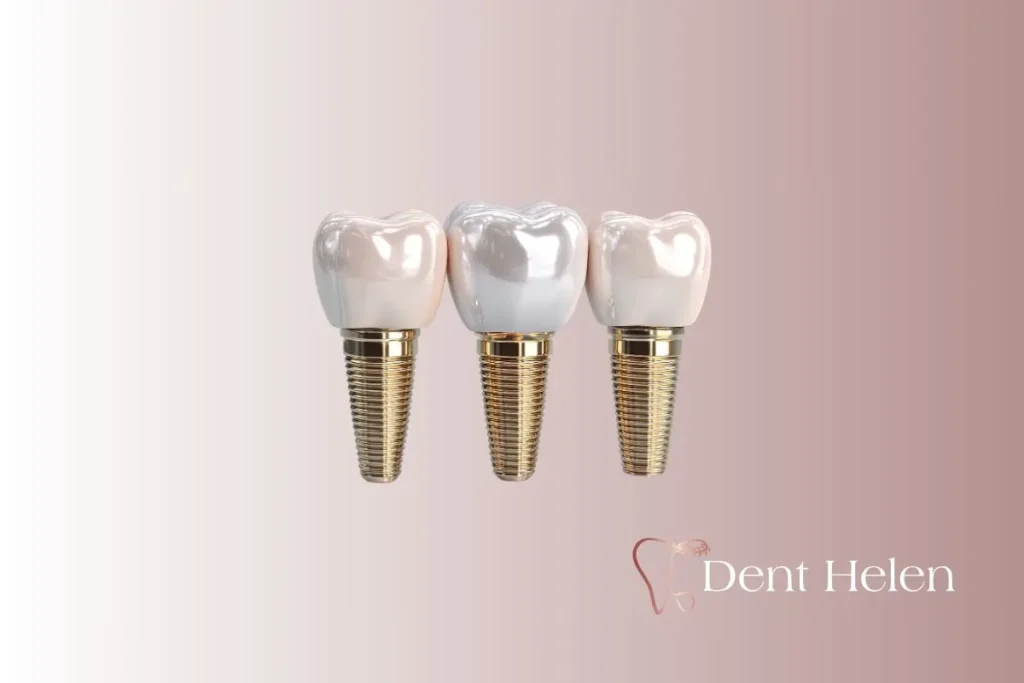 What to Do After Dental Implants? Aftercare & Recovery Guide