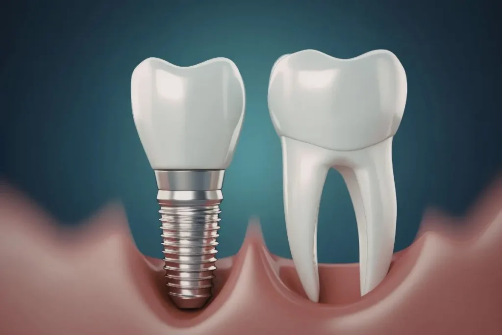 Dental Implants vs Dentures