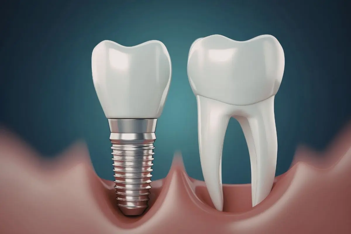 Dental Implants vs Dentures