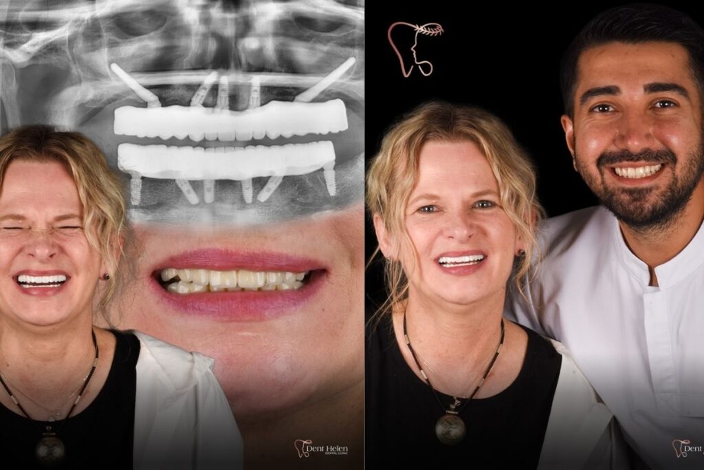 Implante dentário quanto custa em 2026? Guia completo de preços na Turquia