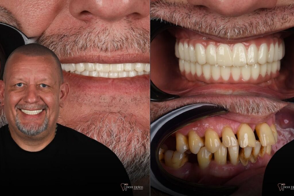 o preço do implante dentário