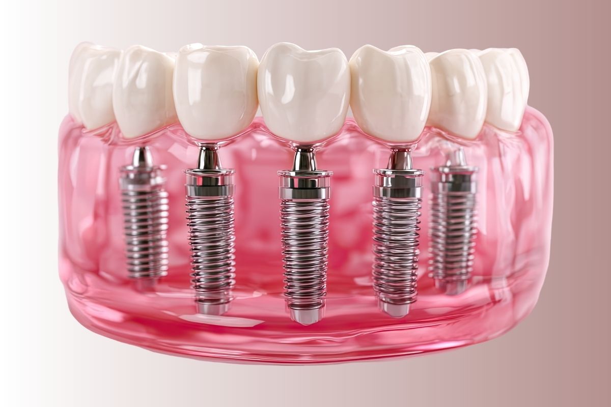 Имплантация зубов в Турции цена полной челюсти в Анталии