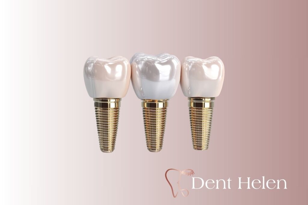 All-on-4 Dental Implants Cost