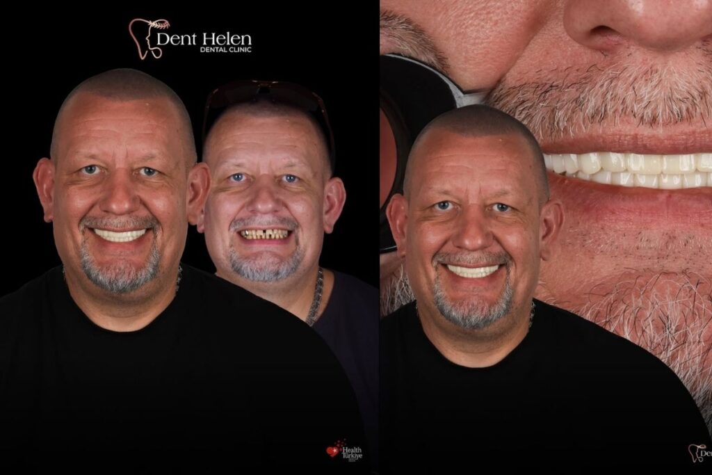 Full Mouth Dental Implants in Turkey: Cost, Procedure & Complete Smile Restoration