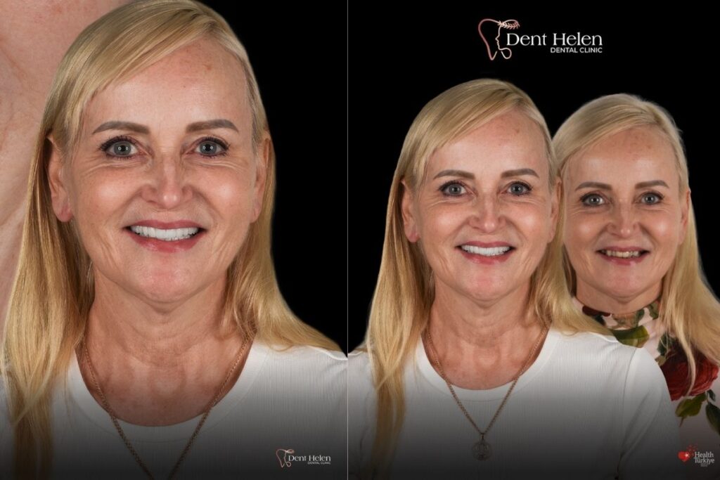 Dent Helen All On Four