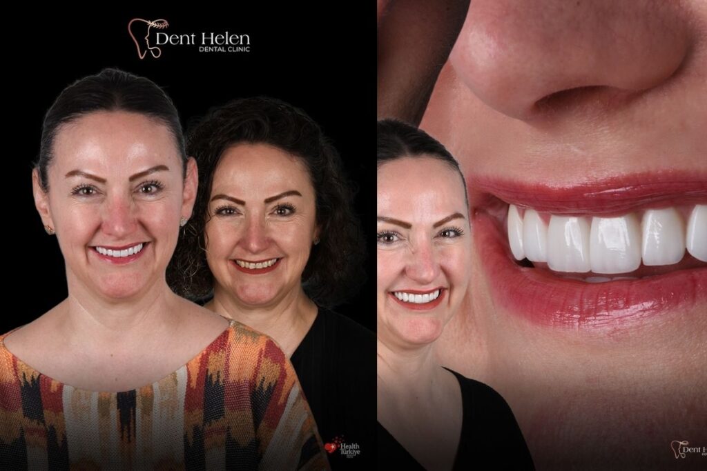 E Max Veneers Cost in Turkey
