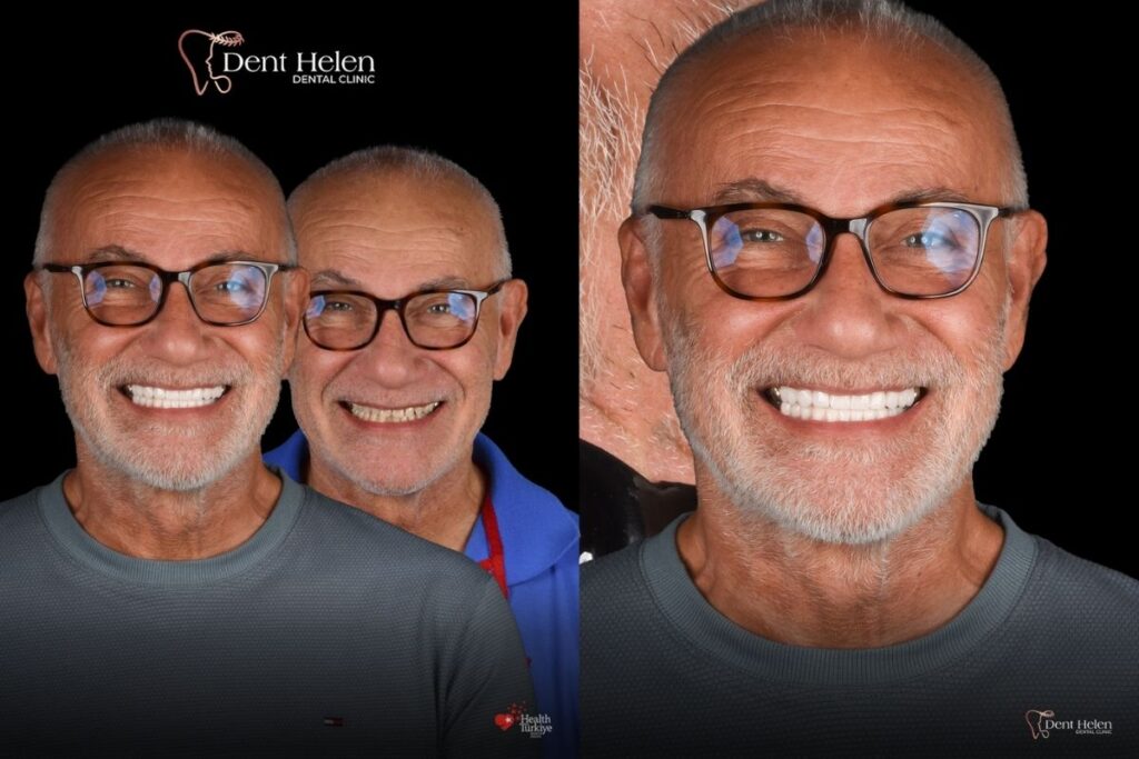 E Max Veneers in Antalya