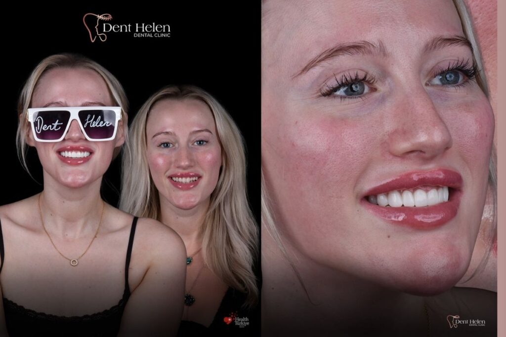 E Max Veneers in Turkey
