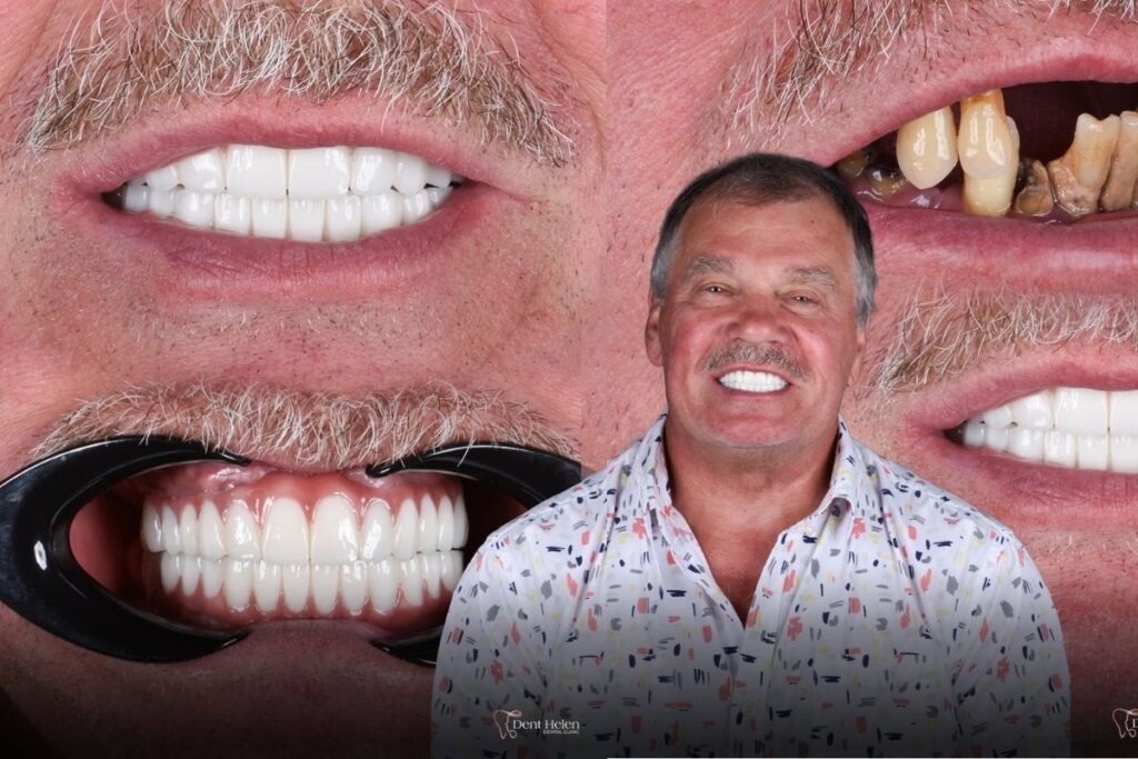 Jak probíhá léčba zubními implantáty