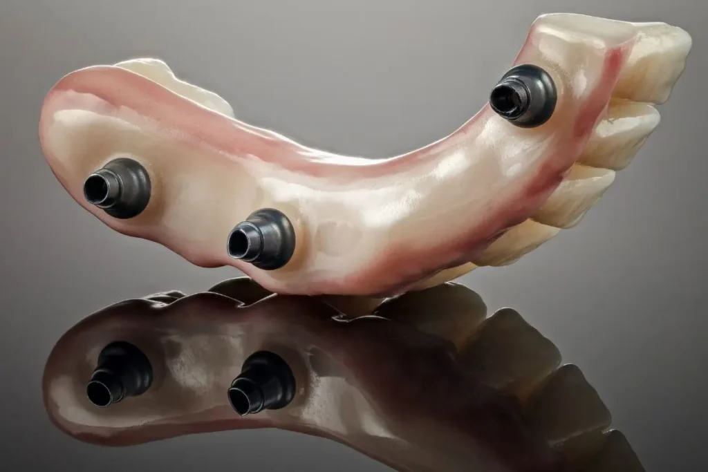 Recuperação Após Implantes Dentários