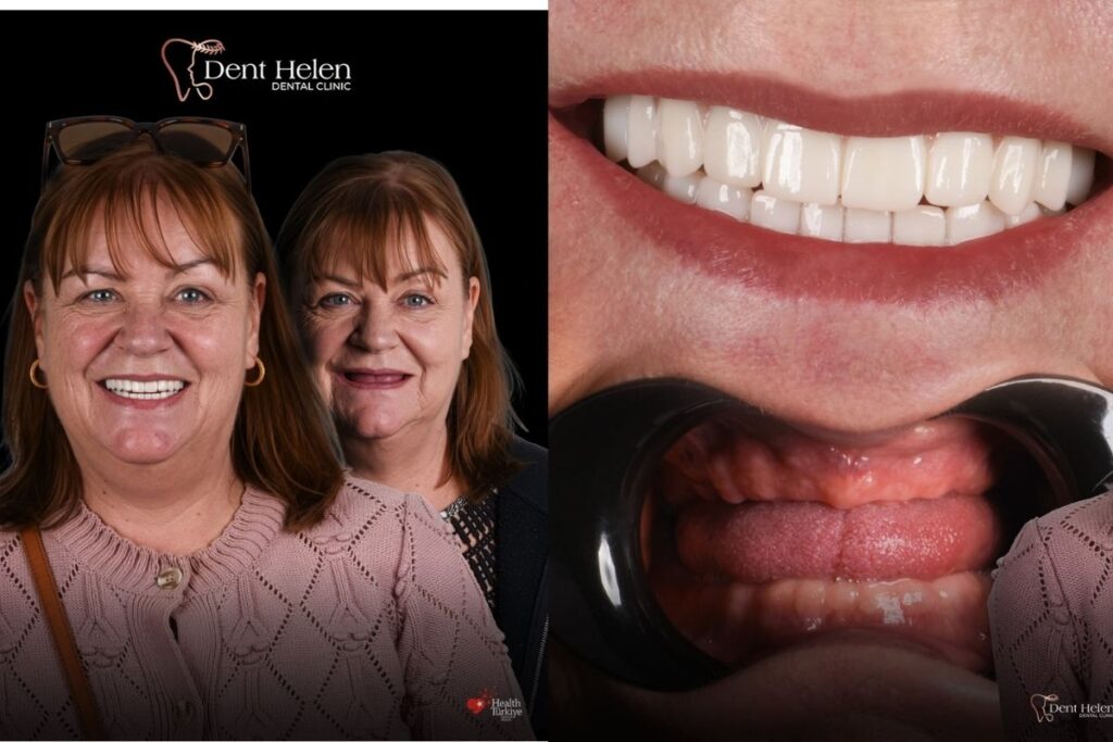 Typy kompletní rekonstrukce chrupu pomocí implantátů