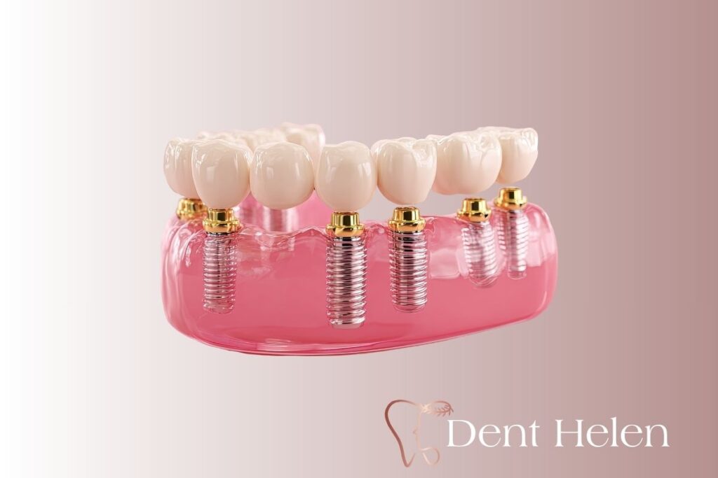 All-on-4 Dental Implants Cost in Antalya: Full Mouth Guide