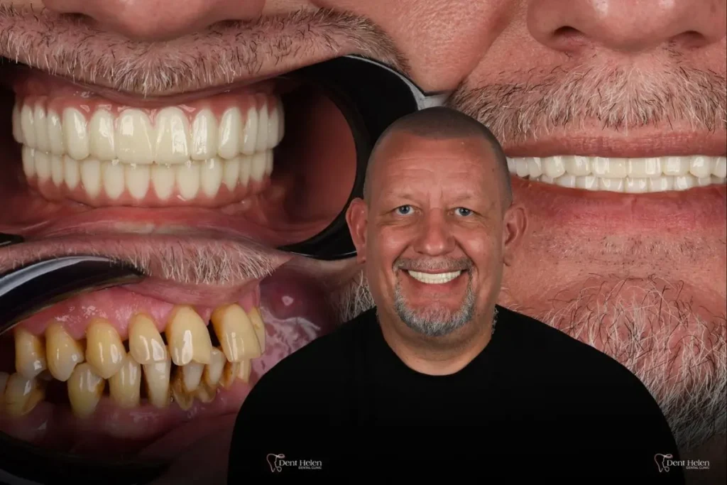 Why Tooth Loss Changes Your Facial Structure