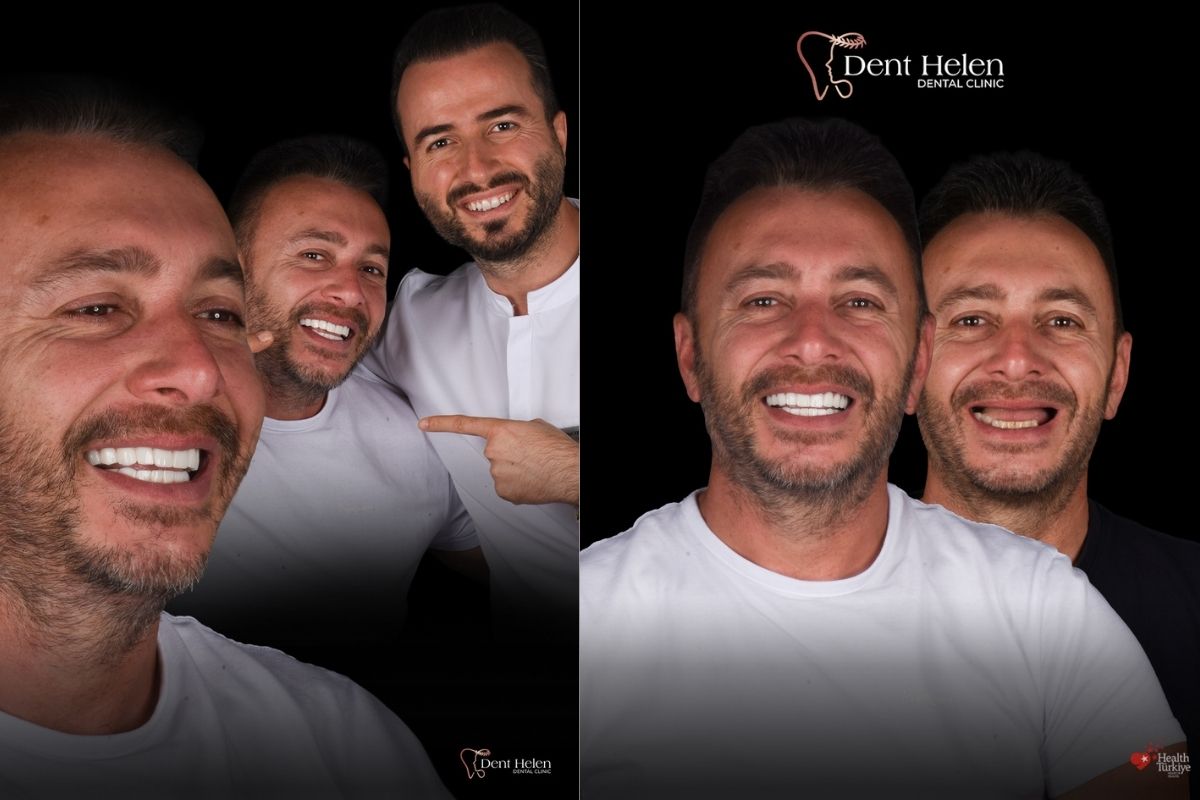 Full Mouth Dental Implants