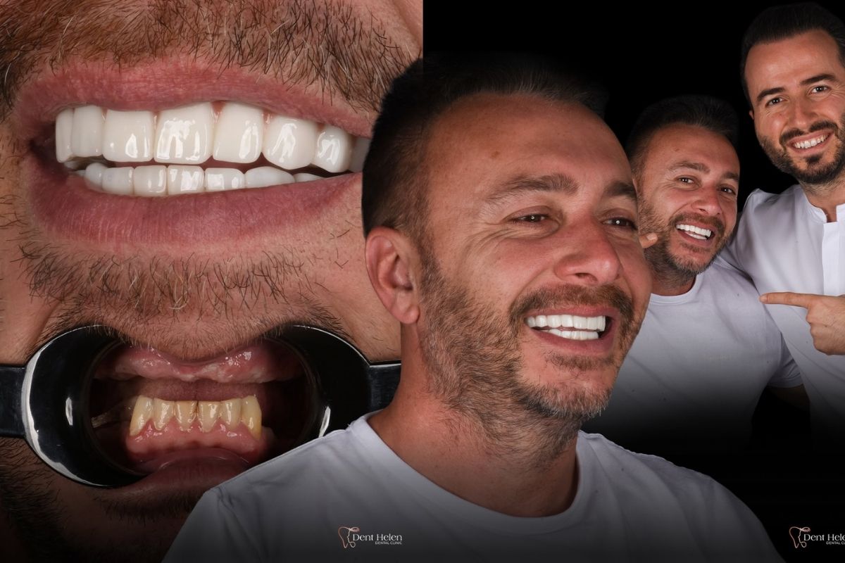 zubních implantátů v Antalyi