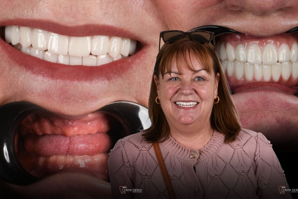 All on 5 Dental Implants in Antalya | Dent Helen