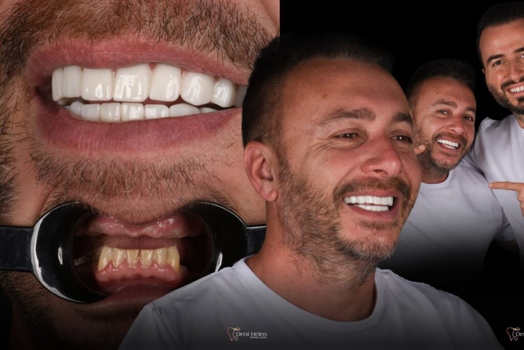 All on 5 Dental Implants