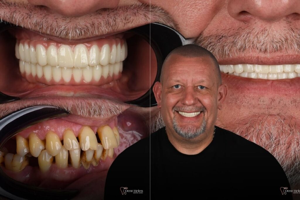 All on 5 Dental cost in Implants