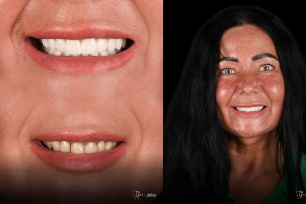 Front Teeth Crowns in Antalya