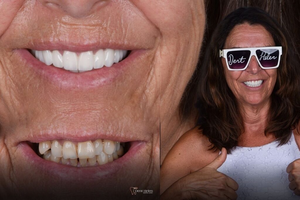 Front Teeth Crowns in Antalya